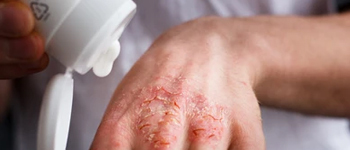 Eczema Treatment