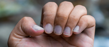 Blue Tinted Nails - Common Nail Problems