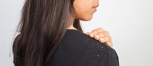 Causes, Symptoms and Side Effects of Dandruff