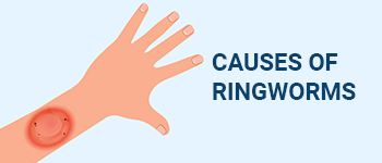 Causes_of_Ringworms