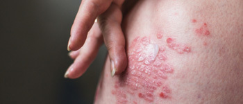 Common Causes of Eczema