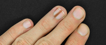 Dark Lines Across your Nail Surface - Common Nail Problems