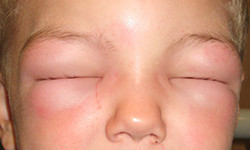 What are the causes of cellulitis of the eyelid? 