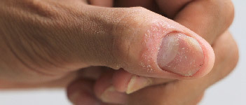  Thickened, ridged or pitted nails, which is also known as Nail Psoriasis