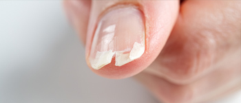 Easily Breakable and Chipped Nails - Common Nail Problems