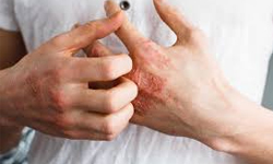 Eczema