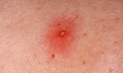 Folliculitis