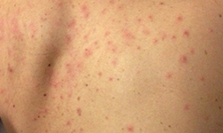 folliculitis 