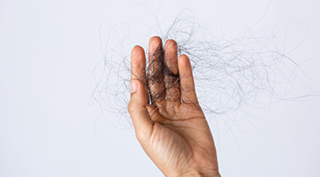 Hair Loss in Men and Women