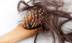 Hair-loss-comes-from-the-mother's-side-of-the-family