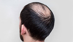Procedure for Hair Transplant for Men