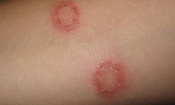 Causes and Symptoms of Ringworm