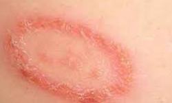 Prevent and Get Rid of Ringworm