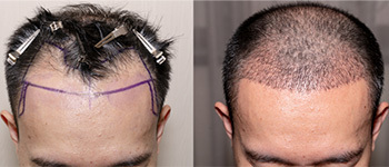 How Is Hair Transplant Done?
