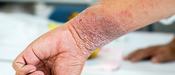 How is Atopic Dermatitis diagnosed?