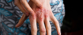 How is Atopic Dermatitis different from other skin diseases?
