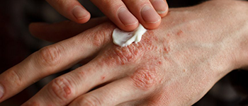 How is Atopic Dermatitis treated?
