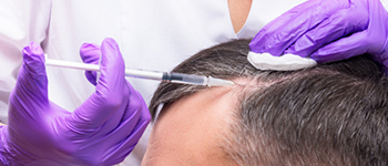 How_Does_PRP_Hair_Loss_Treatment_Work_Point