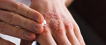 How Can You Identify Psoriasis?