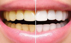 Hydrogen_Peroxide_For_Teeth