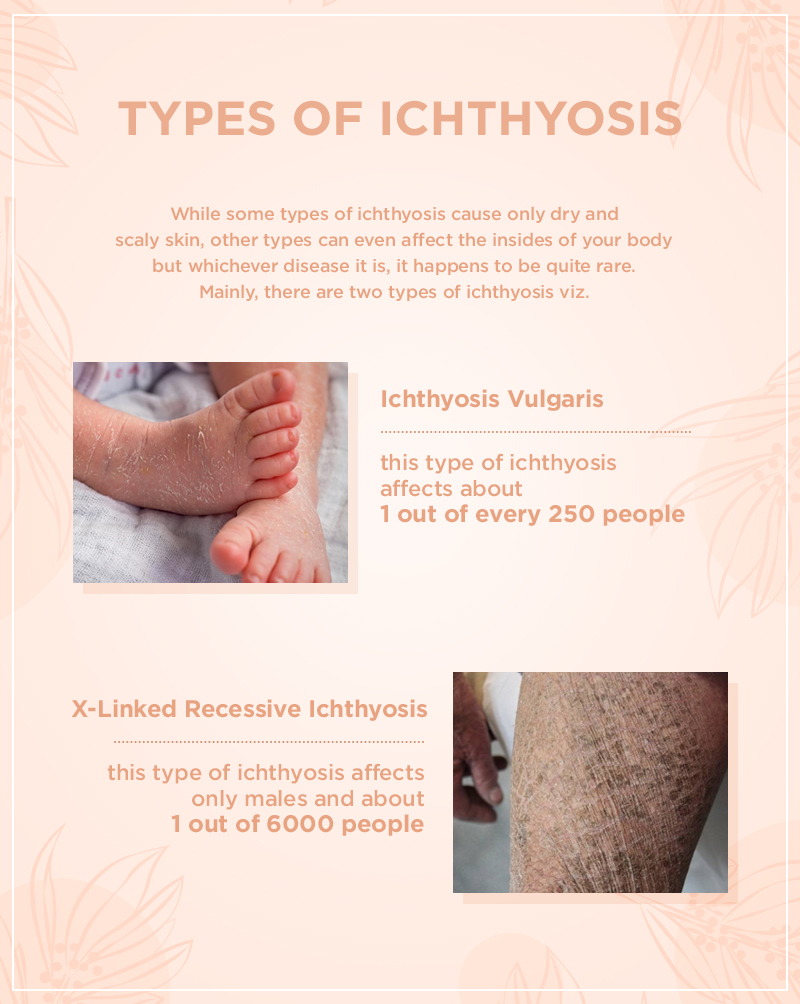 Types-of-Ichthyosis