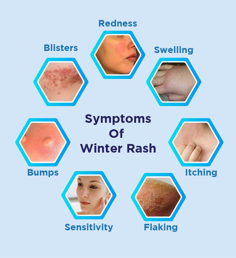 Symptoms Of Winter Rash