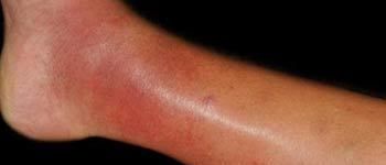 Cellulitis