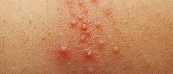 Folliculitis