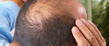 Involutional-Alopecia