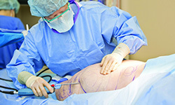 Liposuction_procedure