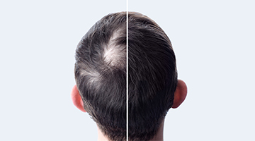 Male Hair Transplant