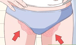 What causes jock itch?