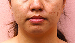 Melasma