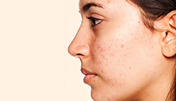 Post inflammatory hyperpigmentation