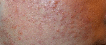 Papules