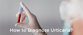 How to Diagnose Urticaria?