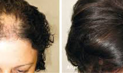 How does Platelet Rich Plasma for Hair Loss Work