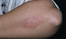 Psoriasis2