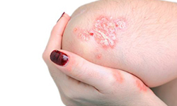 Psoriasis5