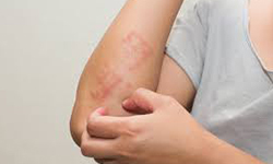 Psoriasis6