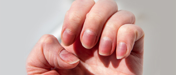 Red and Puffy Nails - Common Nail Problems