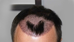 Risks Of Hair Transplant for Men