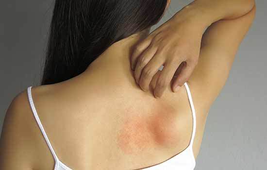 treatment-of-heat-rash