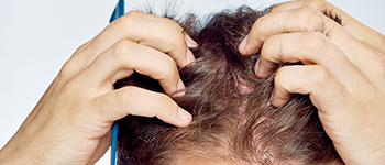 Scalp Psoriasis