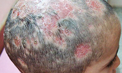 Tinea Versicolor: Causes, Symptoms, & Treatment