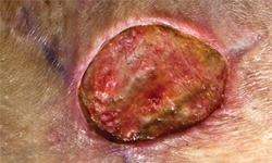 How severe can a staph infection be