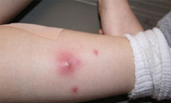 Staph_Infection_On_Your_Skin_Symptoms___Treatment