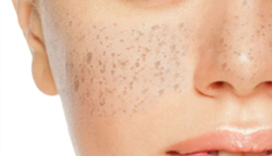 Symptoms-of-hyperpigmentation