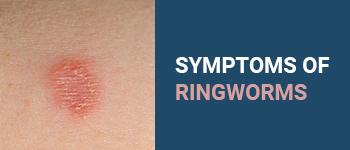 Symptoms_of_Ringworms