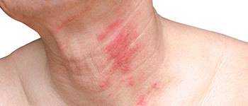 Tinea Fungal Infections